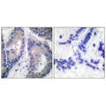 Immunohistochemical analysis of paraffin-embedded human lung carcinoma tissue, using Endostatin antibody.