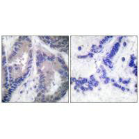 Immunohistochemical analysis of paraffin-embedded human lung carcinoma tissue, using Endostatin antibody.