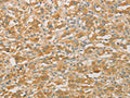 The image on the left is immunohistochemistry of paraffin-embedded Human thyroid cancer tissue using CSB-PA044730(PRPSAP1 Antibody) at dilution 1/50, on the right is treated with fusion protein. (Original magnification: ×200)