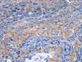 The image on the left is immunohistochemistry of paraffin-embedded Human cervical cancer tissue using CSB-PA044893(MATN3 Antibody) at dilution 1/30, on the right is treated with fusion protein. (Original magnification: ×200)