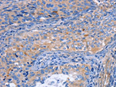 The image on the left is immunohistochemistry of paraffin-embedded Human cervical cancer tissue using CSB-PA044893(MATN3 Antibody) at dilution 1/30, on the right is treated with fusion protein. (Original magnification: ×200)