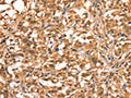The image on the left is immunohistochemistry of paraffin-embedded Human thyroid cancer tissue using CSB-PA045809(ACADVL Antibody) at dilution 1/15, on the right is treated with synthetic peptide. (Original magnification: ×200)