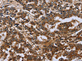 The image on the left is immunohistochemistry of paraffin-embedded Human liver cancer tissue using CSB-PA045962(FH Antibody) at dilution 1/30, on the right is treated with fusion protein. (Original magnification: ×200)