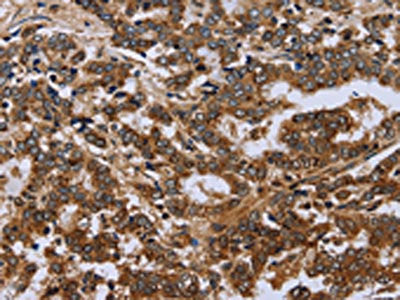 The image on the left is immunohistochemistry of paraffin-embedded Human liver cancer tissue using CSB-PA045962(FH Antibody) at dilution 1/30, on the right is treated with fusion protein. (Original magnification: ×200)