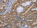 The image on the left is immunohistochemistry of paraffin-embedded Human thyroid cancer tissue using CSB-PA045995(BAG1 Antibody) at dilution 1/40, on the right is treated with fusion protein. (Original magnification: ×200)
