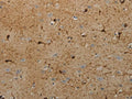 The image on the left is immunohistochemistry of paraffin-embedded Human brain tissue using CSB-PA046504(AATK Antibody) at dilution 1/25, on the right is treated with synthetic peptide. (Original magnification: ×200)