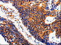 The image on the left is immunohistochemistry of paraffin-embedded Human colon cancer tissue using CSB-PA046670(IL18BP Antibody) at dilution 1/50, on the right is treated with fusion protein. (Original magnification: ×200)