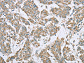 The image on the left is immunohistochemistry of paraffin-embedded Human colon cancer tissue using CSB-PA046947(ECHS1 Antibody) at dilution 1/20, on the right is treated with fusion protein. (Original magnification: ×200)