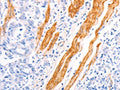 The image on the left is immunohistochemistry of paraffin-embedded Human gastric cancer tissue using CSB-PA047043(TPM1 Antibody) at dilution 1/40, on the right is treated with fusion protein. (Original magnification: ×200)