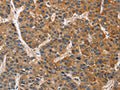 The image on the left is immunohistochemistry of paraffin-embedded Human liver cancer tissue using CSB-PA047722(BRE Antibody) at dilution 1/40, on the right is treated with fusion protein. (Original magnification: ×200)