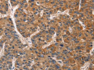 The image on the left is immunohistochemistry of paraffin-embedded Human liver cancer tissue using CSB-PA047722(BRE Antibody) at dilution 1/40, on the right is treated with fusion protein. (Original magnification: ×200)
