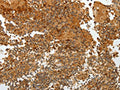 The image on the left is immunohistochemistry of paraffin-embedded Human tonsil tissue using CSB-PA048054(TFF2 Antibody) at dilution 1/40, on the right is treated with fusion protein. (Original magnification: ×200)