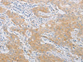 The image on the left is immunohistochemistry of paraffin-embedded Human gastic cancer tissue using CSB-PA048149(PDE4D Antibody) at dilution 1/20, on the right is treated with fusion protein. (Original magnification: ×200)