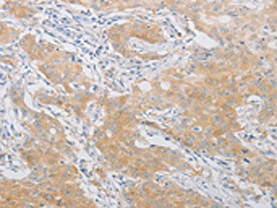The image on the left is immunohistochemistry of paraffin-embedded Human gastic cancer tissue using CSB-PA048149(PDE4D Antibody) at dilution 1/20, on the right is treated with fusion protein. (Original magnification: ×200)