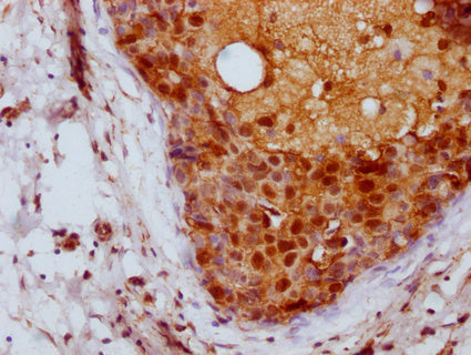 IHC image of CSB-PA04837A0Rb diluted at 1:100 and staining in paraffin-embedded human breast cancer performed on a Leica BondTM system. After dewaxing and hydration, antigen retrieval was mediated by high pressure in a citrate buffer (pH 6.0). Section was blocked with 10% normal goat serum 30min at RT. Then primary antibody (1% BSA) was incubated at 4°C overnight. The primary is detected by a Goat anti-rabbit IgG labeled by HRP and visualized using 0.05% DAB.
