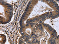 The image is immunohistochemistry of paraffin-embedded Human colon cancer tissue using CSB-PA048430(FSTL1 Antibody) at dilution 1/30. (Original magnification: ×200)