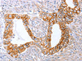 The image on the left is immunohistochemistry of paraffin-embedded Human cervical cancer tissue using CSB-PA048521(ABO Antibody) at dilution 1/50, on the right is treated with synthetic peptide. (Original magnification: ×200)