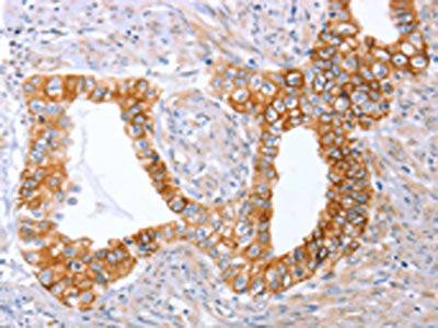 The image on the left is immunohistochemistry of paraffin-embedded Human cervical cancer tissue using CSB-PA048521(ABO Antibody) at dilution 1/50, on the right is treated with synthetic peptide. (Original magnification: ×200)