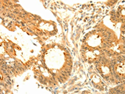 The image on the left is immunohistochemistry of paraffin-embedded Human colon cancer tissue using CSB-PA048810(SOCS6 Antibody) at dilution 1/50, on the right is treated with fusion protein. (Original magnification: ×200)