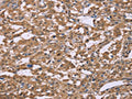 The image on the left is immunohistochemistry of paraffin-embedded Human liver cancer tissue using CSB-PA048892(IFNA2 Antibody) at dilution 1/40, on the right is treated with synthetic peptide. (Original magnification: ×200)