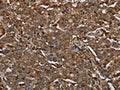 The image on the left is immunohistochemistry of paraffin-embedded Human liver cancer tissue using CSB-PA048999(ARHGDIA Antibody) at dilution 1/30, on the right is treated with fusion protein. (Original magnification: ×200)