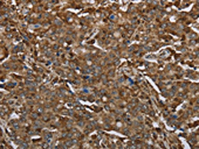 The image on the left is immunohistochemistry of paraffin-embedded Human liver cancer tissue using CSB-PA048999(ARHGDIA Antibody) at dilution 1/30, on the right is treated with fusion protein. (Original magnification: ×200)