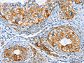 The image on the left is immunohistochemistry of paraffin-embedded Human cervical cancer tissue using CSB-PA049334(AIP Antibody) at dilution 1/80, on the right is treated with synthetic peptide. (Original magnification: ×200)