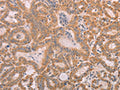 The image on the left is immunohistochemistry of paraffin-embedded Human thyroid cancer tissue using CSB-PA049349(SMAD5 Antibody) at dilution 1/25, on the right is treated with fusion protein. (Original magnification: ×200)
