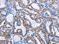 The image on the left is immunohistochemistry of paraffin-embedded Human thyroid cancer tissue using CSB-PA049381(FHIT Antibody) at dilution 1/25, on the right is treated with fusion protein. (Original magnification: ×200)
