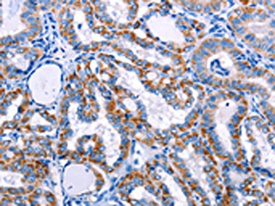 The image on the left is immunohistochemistry of paraffin-embedded Human thyroid cancer tissue using CSB-PA049381(FHIT Antibody) at dilution 1/25, on the right is treated with fusion protein. (Original magnification: ×200)