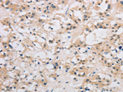 The image on the left is immunohistochemistry of paraffin-embedded Human thyroid cancer tissue using CSB-PA049554(DDIT4L Antibody) at dilution 1/40, on the right is treated with fusion protein. (Original magnification: ×200)