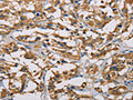 The image on the left is immunohistochemistry of paraffin-embedded Human thyroid cancer tissue using CSB-PA049702(PIP4K2A Antibody) at dilution 1/50, on the right is treated with fusion protein. (Original magnification: ×200)