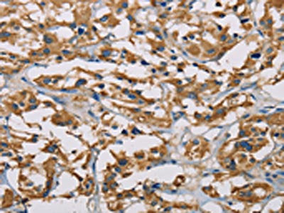 The image on the left is immunohistochemistry of paraffin-embedded Human thyroid cancer tissue using CSB-PA049702(PIP4K2A Antibody) at dilution 1/50, on the right is treated with fusion protein. (Original magnification: ×200)