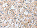 The image on the left is immunohistochemistry of paraffin-embedded Human thyroid cancer tissue using CSB-PA049918(LY96 Antibody) at dilution 1/20, on the right is treated with fusion protein. (Original magnification: ×200)