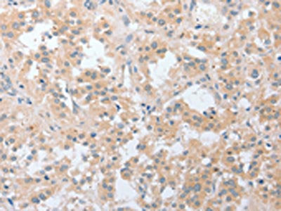 The image on the left is immunohistochemistry of paraffin-embedded Human thyroid cancer tissue using CSB-PA049918(LY96 Antibody) at dilution 1/20, on the right is treated with fusion protein. (Original magnification: ×200)