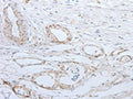 The image on the left is immunohistochemistry of paraffin-embedded Human esophagus cancer tissue using CSB-PA050912(SLC5A5 Antibody) at dilution 1/25, on the right is treated with synthetic peptide. (Original magnification: ×200)