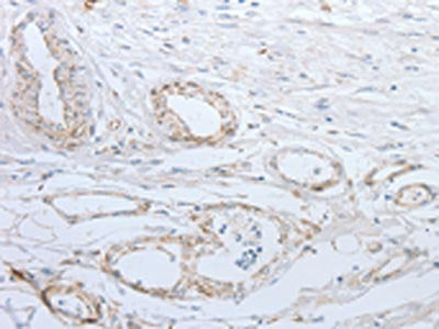The image on the left is immunohistochemistry of paraffin-embedded Human esophagus cancer tissue using CSB-PA050912(SLC5A5 Antibody) at dilution 1/25, on the right is treated with synthetic peptide. (Original magnification: ×200)
