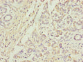 Immunohistochemistry of paraffin-embedded human pancreatic cancer using CSB-PA05104A0Rb at dilution of 1:100
