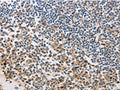 The image on the left is immunohistochemistry of paraffin-embedded Human tonsil tissue using CSB-PA051370(MSH6 Antibody) at dilution 1/10, on the right is treated with fusion protein. (Original magnification: ×200)