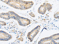 The image on the left is immunohistochemistry of paraffin-embedded Human colon cancer tissue using CSB-PA051678(ABHD1 Antibody) at dilution 1/15, on the right is treated with fusion protein. (Original magnification: ×200)