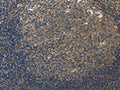 The image on the left is immunohistochemistry of paraffin-embedded Human tonsil tissue using CSB-PA052047(DUSP26 Antibody) at dilution 1/50, on the right is treated with fusion protein. (Original magnification: ×200)
