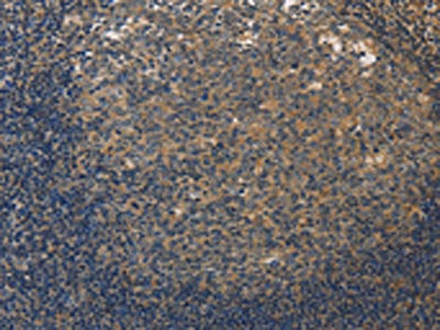 The image on the left is immunohistochemistry of paraffin-embedded Human tonsil tissue using CSB-PA052047(DUSP26 Antibody) at dilution 1/50, on the right is treated with fusion protein. (Original magnification: ×200)
