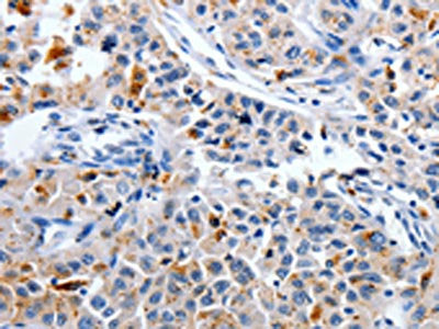 The image on the left is immunohistochemistry of paraffin-embedded Human lung cancer tissue using CSB-PA052625(CDK3 Antibody) at dilution 1/30, on the right is treated with synthetic peptide. (Original magnification: ×200)