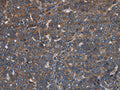 The image on the left is immunohistochemistry of paraffin-embedded Human ovarian cancer tissue using CSB-PA053347(LETMD1 Antibody) at dilution 1/30, on the right is treated with fusion protein. (Original magnification: ×200)