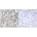 Immunohistochemistry analysis of paraffin-embedded human breast carcinoma tissue using Collagen VI α3 antibody.