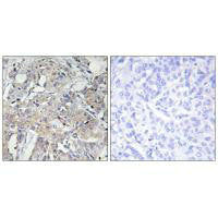 Immunohistochemistry analysis of paraffin-embedded human breast carcinoma tissue using Collagen VI α3 antibody.