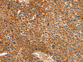 The image on the left is immunohistochemistry of paraffin-embedded Human liver cancer tissue using CSB-PA053602(ALDH1A2 Antibody) at dilution 1/30, on the right is treated with synthetic peptide. (Original magnification: ×200)
