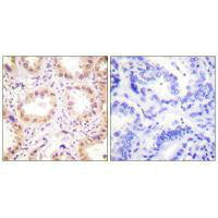 Immunohistochemistry analysis of paraffin-embedded human lung carcinoma tissue using NEDD8 antibody.