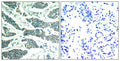Immunohistochemical analysis of paraffin-embedded human breast carcinoma tissue using AKT1/AKT2/AKT3(Ab-315/316/312) Antibody(left) or the same antibody preincubated with blocking peptide(right).
