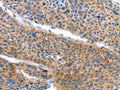 The image on the left is immunohistochemistry of paraffin-embedded Human liver cancer tissue using CSB-PA054255(ARL11 Antibody) at dilution 1/50, on the right is treated with fusion protein. (Original magnification: ×200)